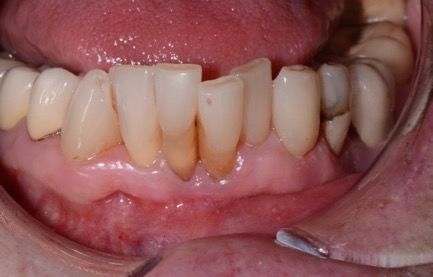 uneven teeth and exposed tooth roots before implant placement