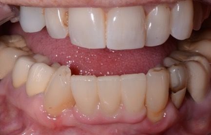 a healthy, even-looking smile after dental implants