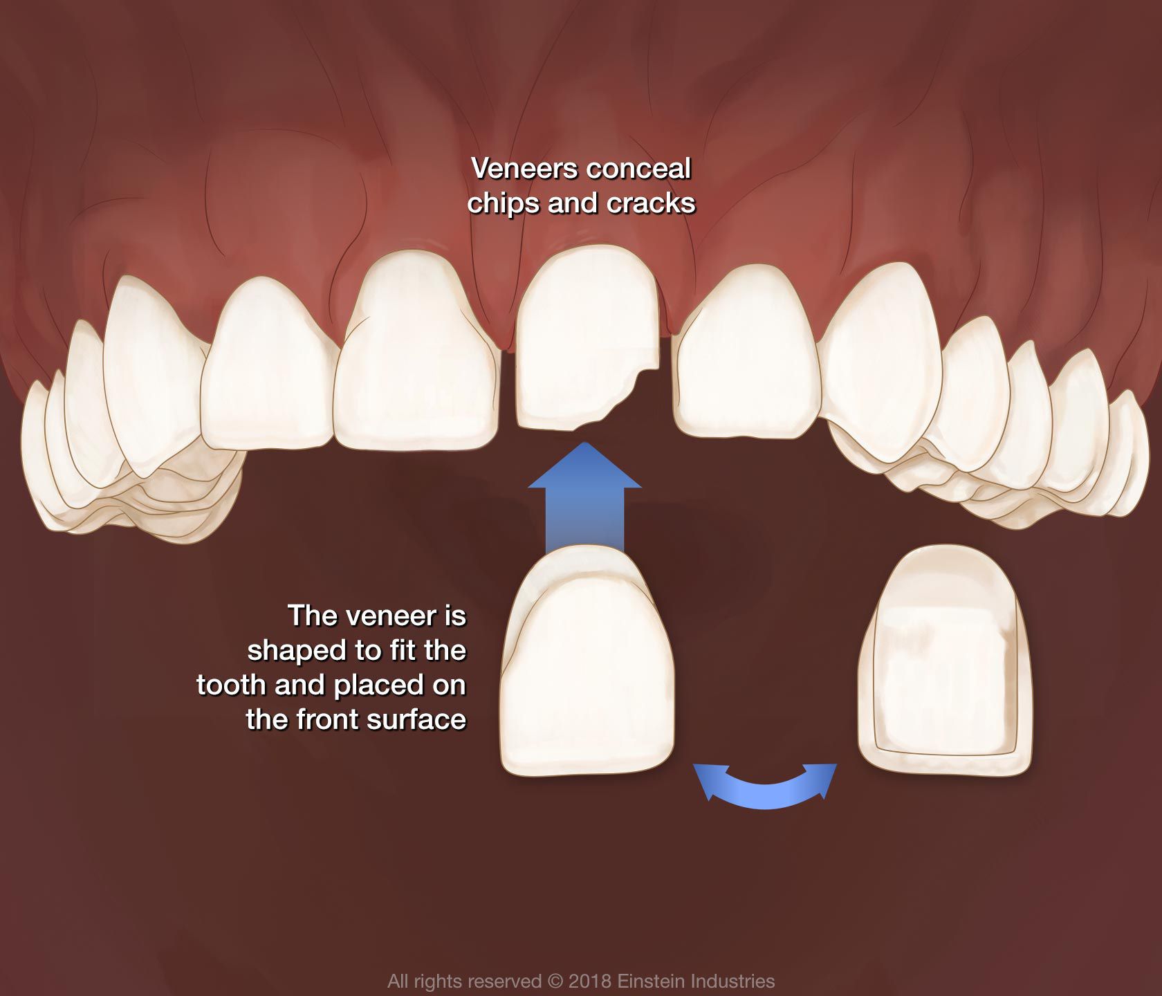 dental veneer
